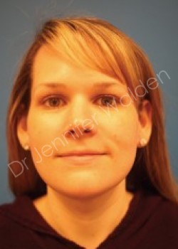 Venus Freeze after photo. Individual results may vary.