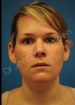 Venus Freeze before photo. Individual results may vary.