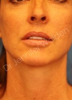Venus Freeze after photo. Individual results may vary.