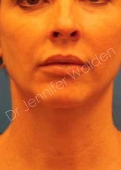 Venus Freeze before photo. Individual results may vary.
