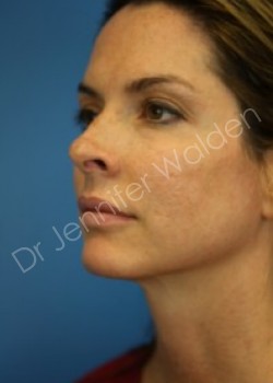 Venus Freeze after photo. Individual results may vary.