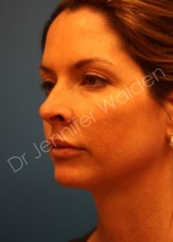 Venus Freeze before photo. Individual results may vary.