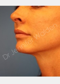 Venus Freeze after photo. Individual results may vary.