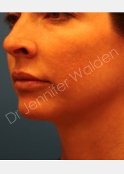 Venus Freeze before photo. Individual results may vary.