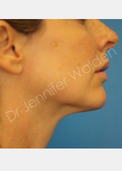 Venus Freeze after photo. Individual results may vary.