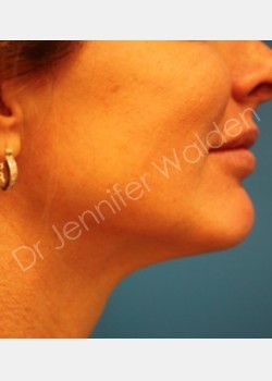Venus Freeze before photo. Individual results may vary.