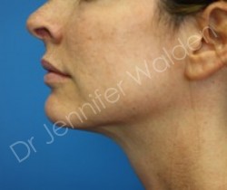Venus Freeze after photo. Individual results may vary.