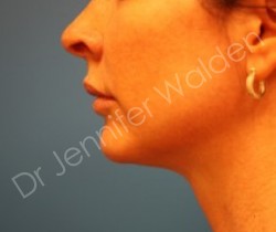 Venus Freeze before photo. Individual results may vary.