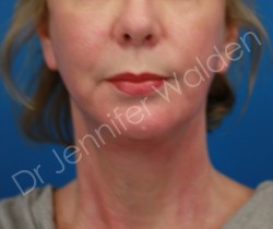 Venus Freeze after photo. Individual results may vary.