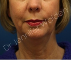 Venus Freeze before photo. Individual results may vary.