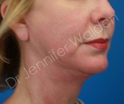 Venus Freeze after photo. Individual results may vary.