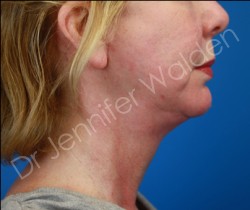 Venus Freeze after photo. Individual results may vary.