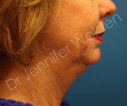 Venus Freeze before photo. Individual results may vary.
