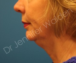 Venus Freeze before photo. Individual results may vary.