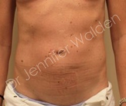 Venus Freeze before photo. Individual results may vary.