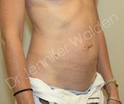 Venus Freeze before photo. Individual results may vary.