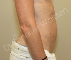 Venus Freeze before photo. Individual results may vary.