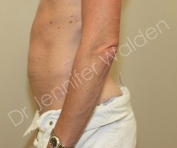 Venus Freeze before photo. Individual results may vary.