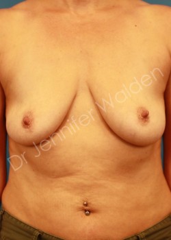 Before Image: Breast augmentation - front