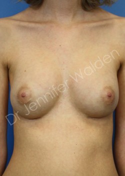 After Image: Breast Reconstruction - front