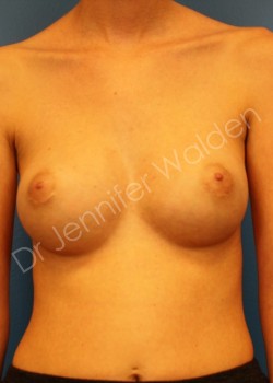 Before Image: Breast Reconstruction - front