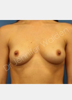 Before Image: Breast Augmentation -silicone - front