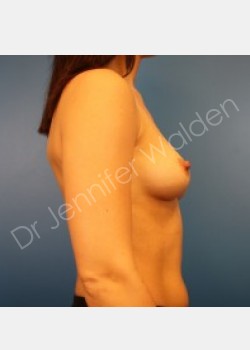 Before Image: Breast Augmentation -silicone - left-side