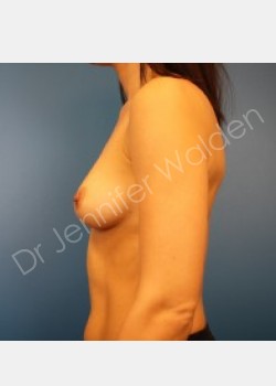 Before Image: Breast Augmentation -silicone - right-side