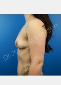 Before Image: Breast Augmentation - right-side