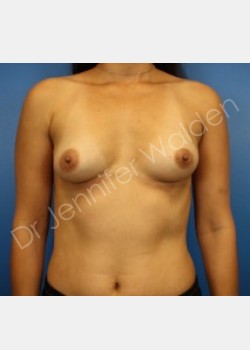 Before Image: Breast Augmentation - front