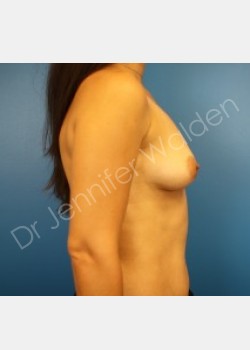 Before Image: Breast Augmentation - right-side