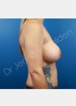 After Image: Breast Augmentation - right-side