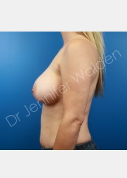 After Image: Breast Augmentation - left-side