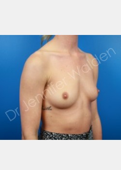Before Image: Breast Augmentation - right-front-oblique