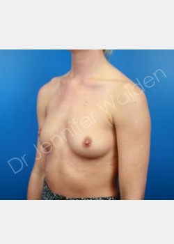 Before Image: Breast Augmentation - left-front-oblique
