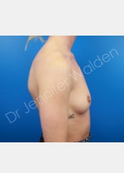 Before Image: Breast Augmentation - right-side