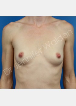 Before Image: Breast Augmentation - front
