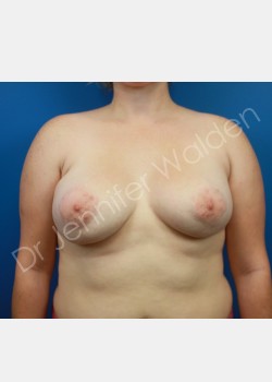 After Image: Breast Augmentation - front