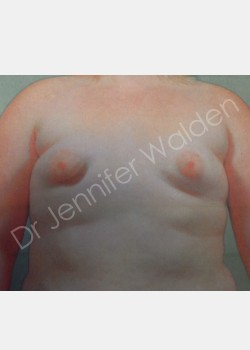 Before Image: Breast Augmentation - front