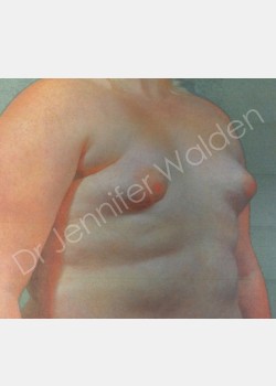 Before Image: Breast Augmentation - right-front-oblique