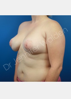 After Image: Breast Augmentation - left-front-oblique