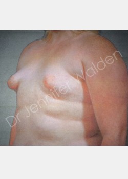 Before Image: Breast Augmentation - left-front-oblique