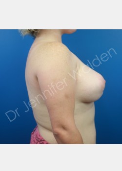 After Image: Breast Augmentation - right-side