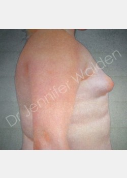 Before Image: Breast Augmentation - right-side