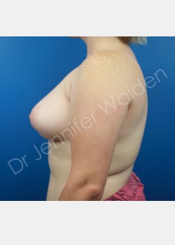 After Image: Breast Augmentation - left-side