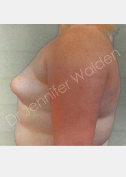 Before Image: Breast Augmentation - left-side