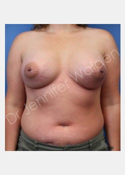 After Image: Breast Augmentation - front