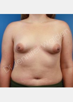 Before Image: Breast Augmentation - front