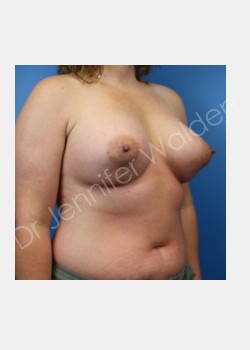 After Image: Breast Augmentation - front