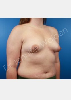 Before Image: Breast Augmentation - front